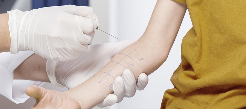 Child having done skin prick allergy test